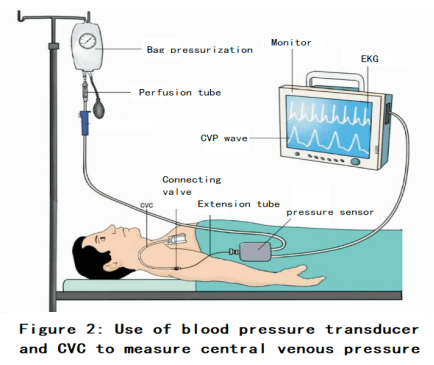 measuring central venous pressure
