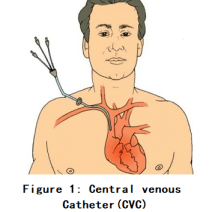 An Introduction Of SCW Central Venous Catheter