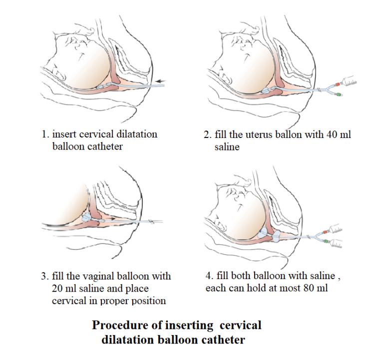 cervical dilation balloon catheter