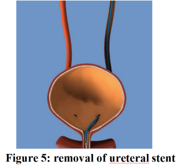 Ureteral stents